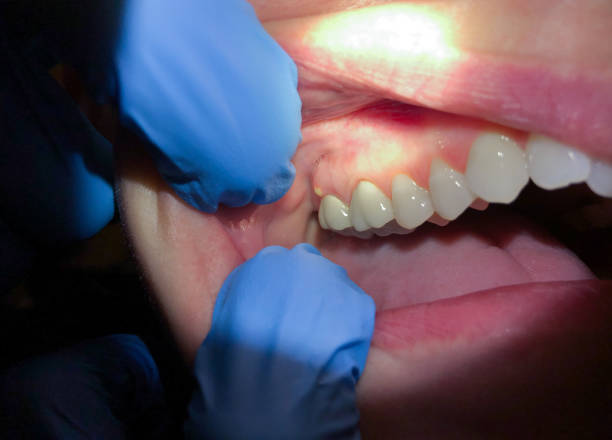 Teeth Whitening in SC
